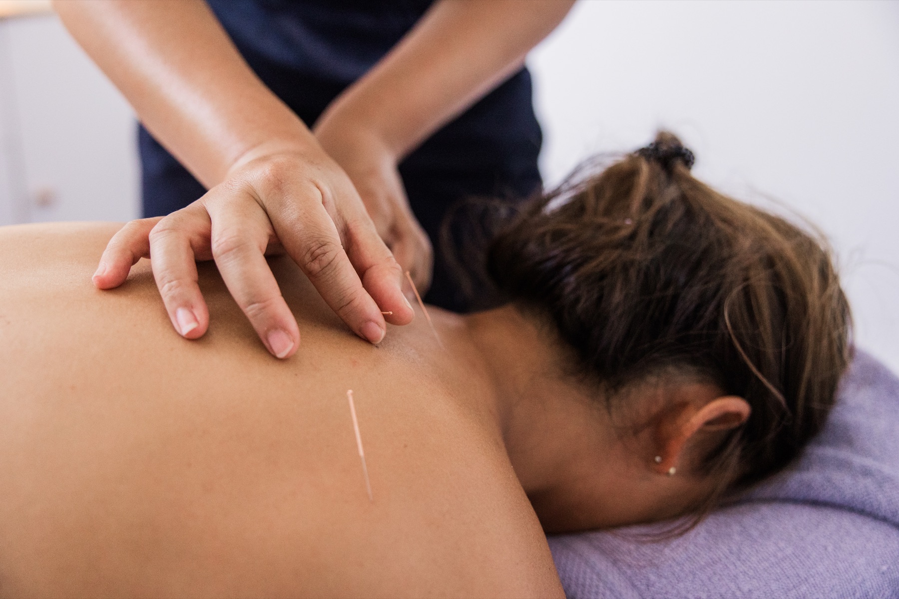 Close-up of dry needling treatment on the upper back